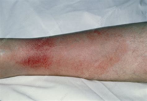 Cellulitis On The Leg Stock Image M1300322 Science Photo Library