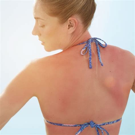Sunburn Itch Relief — How To Stop Hells Itch