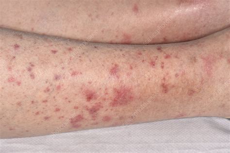 Allergic Vasculitis Stock Image C0498696 Science Photo Library