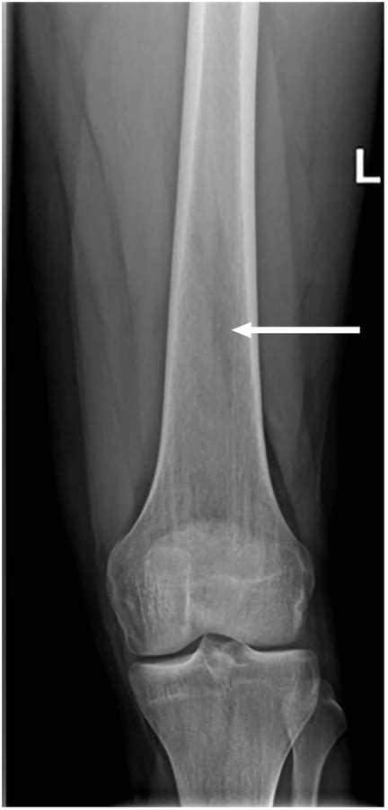 Conventional X Ray Of The Left Distal Femur Showing Intramedullary