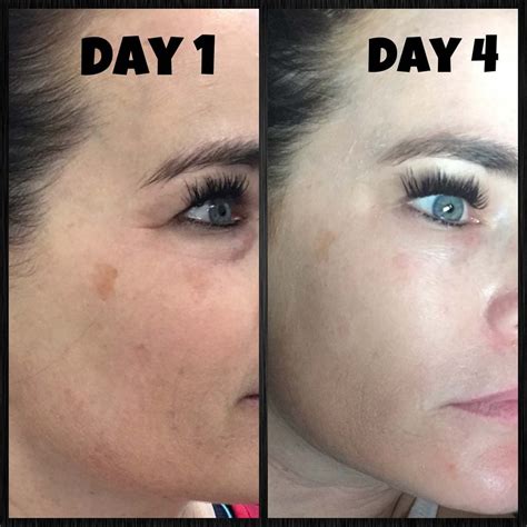 Chemical Peel At Home Before And After 25 Tca Peel Diary Makeup Beauty Reviews A Chemical