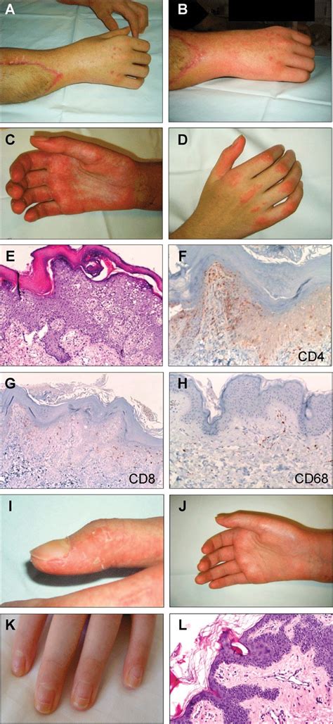 Patient 3 At Day 51 Erythematous Papules Were Observed On The Dorsal