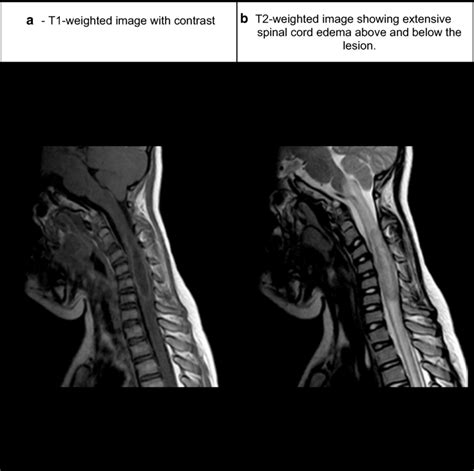 Cervical Spinal Cord Lesion Mri