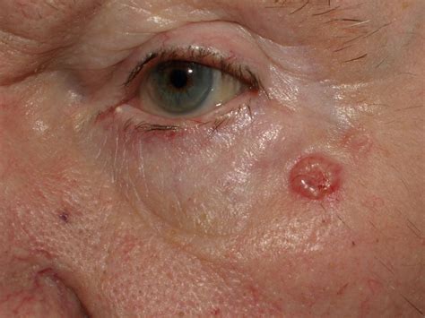 Basalioma O Carcinoma Basocellulare Cosè Cause Sintomi E