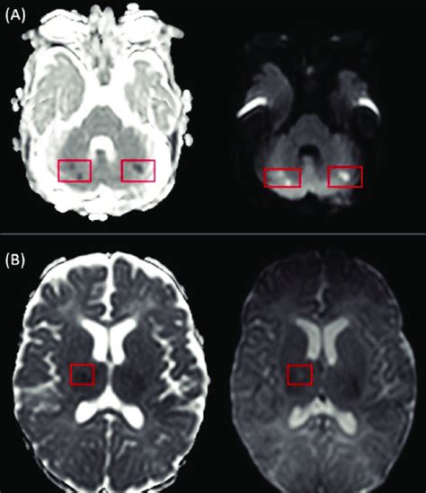 Mri Brain Apparent Diffusion Coefficientdiffusion Weighted Imaging