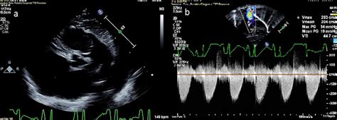 Initial Post Natal Echocardiogram A Image In Parasternal Long Axis View