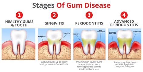 Stages Of Gum Disease Tartar Periodontitis Moving Gums Healthy