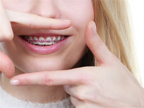 Braces Fort Collins Affordable Orthodontist Near Me