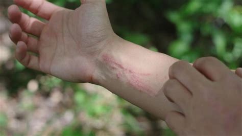 Things To Know About Poison Ivy Rash
