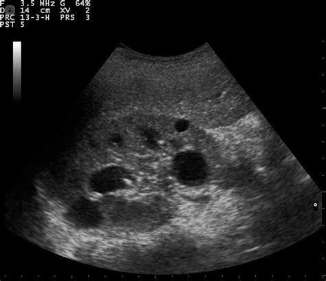 Adult Polycystic Kidney Disease Ultrasound