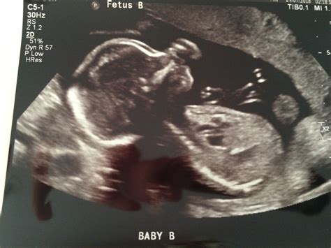 20 Weeks Pregnant With Twins Ultrasound