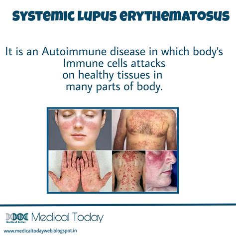 Medical Today Systemic Lupus Erythematosus SLE