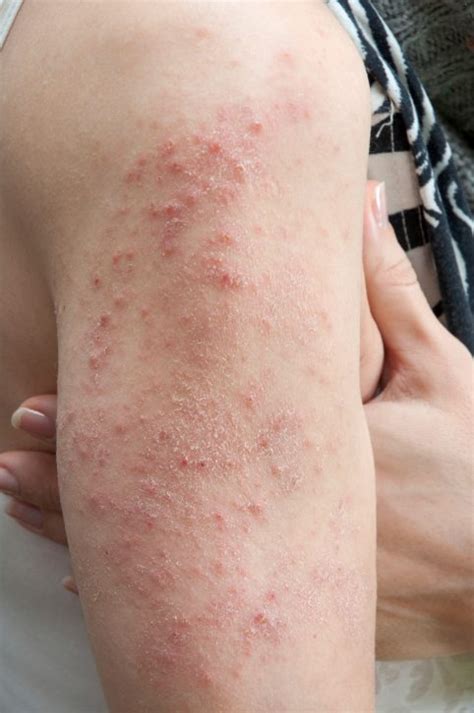 What Is The Skin Rash Dermatitis Herpetiformis Allergic Living