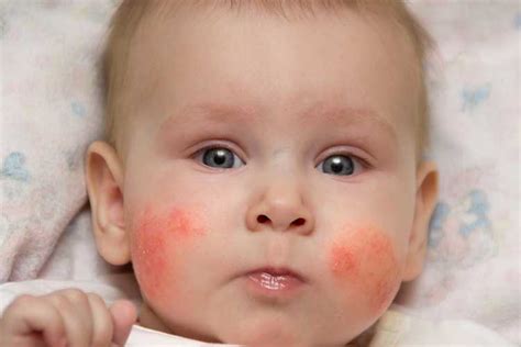 11 Home Remedies To Treat Itching Rash In Babies Theblessedmom