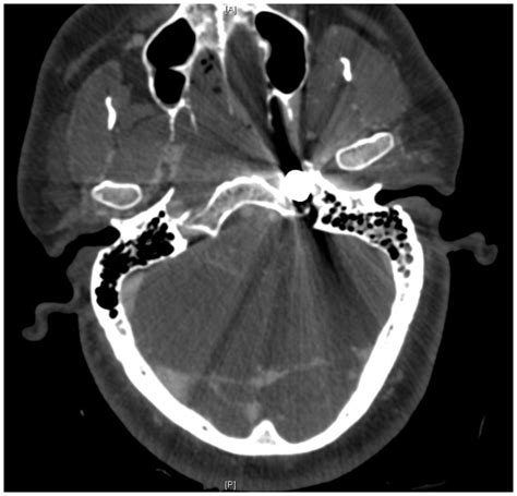 Pre Operative Ct Scan Showing Complete Transection Of The Petrous