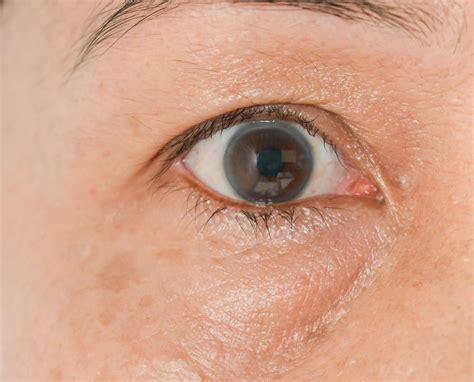 Puffy Eyes Causes And Treatments For Bags Under Your Eyes
