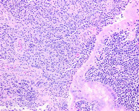 Pathology Outlines Extranodal Marginal Zone Lymphoma Of Mucosa