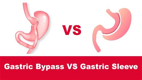 Gastric Sleeve Vs Gastric Bypass Differences Pros Cons