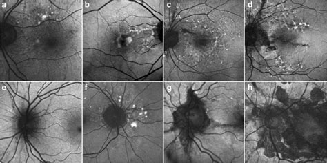 Ad Examples Of The Pattern Dystrophy Like Changes Observed On Fundus