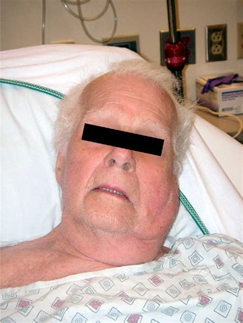 Figure 1 From Elderly Male With Cheek Swelling Acute Suppurative