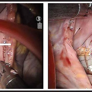 Endoscopic Views During Robotic Repair Show ASD A Tear In The Anterior