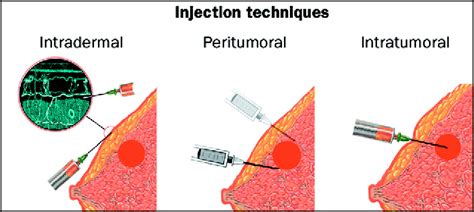 Clinical Role Of Sentinel Lymph Node Biopsy In Breast Cancer The