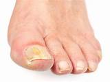 Big Toenail Infection Home Remedies Images