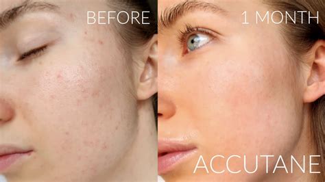 MONTH ACCUTANE JOURNEY PROGRESS FOR MILD ACNE SIDE EFFECTS SKINCARE YouTube