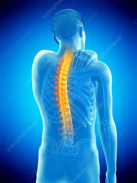 Back Pain Conceptual Illustration Stock Image F0257673 Science