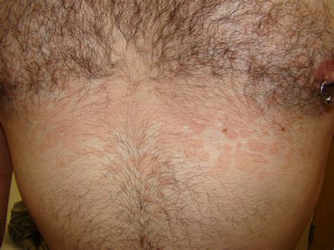 Brown Spots On Chest