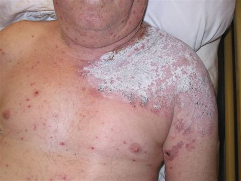 Zona – Herpes zoster thoracicus - DocCheck Pictures