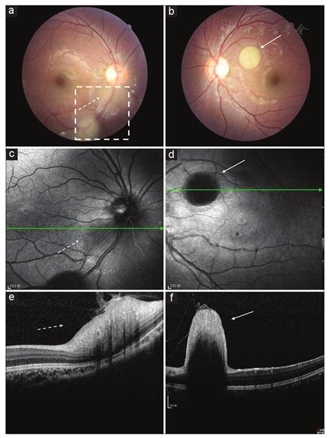 Comparison Of Color Fundus Photography Infrared Fundus Photography