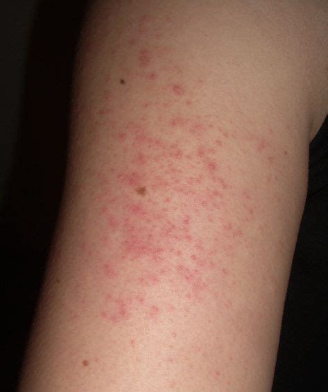 Stress Rash Is One Of The Most Common Symptoms Of Stress Learn What