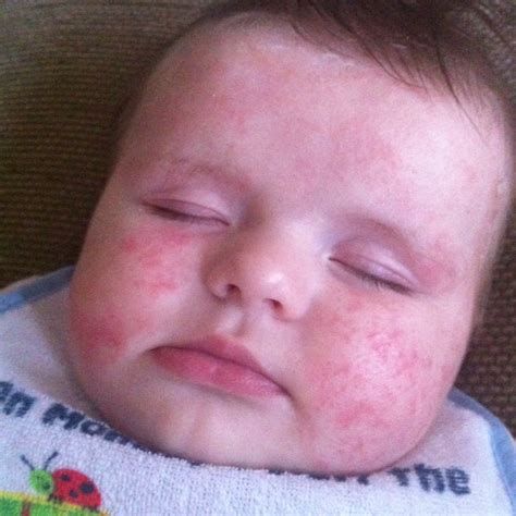 Roseola Rash Pictures In Children Pictures Photos