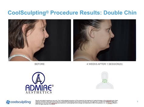 Before And After Pictures Coolsculpting Transformation Images
