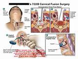 Cervical Discectomy Recovery Pictures