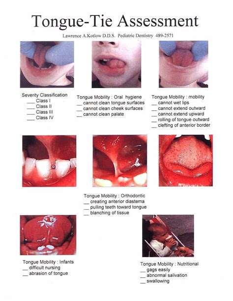 Tongue Tie Assessment By Lawrence A Kotlow Dd S Pediatric