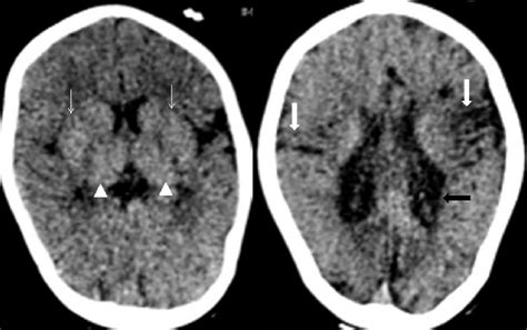 Noncontrast Computed Tomography Head Axial In A 3‑year‑old Term Male