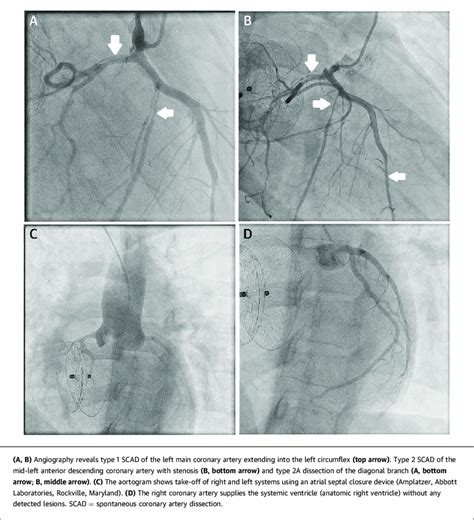 Angiography Reveals Type 1 Scad Of The Left Main Coronary Artery