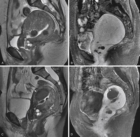 Adenomyosis Uterus MRI