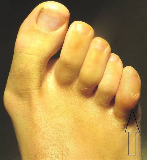 West Vancouver Foot Clinic Hammertoe And Bunion Surgical Procedures