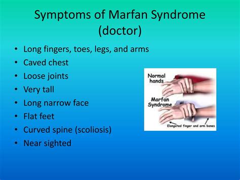 Sindrome De Marfan Fotos