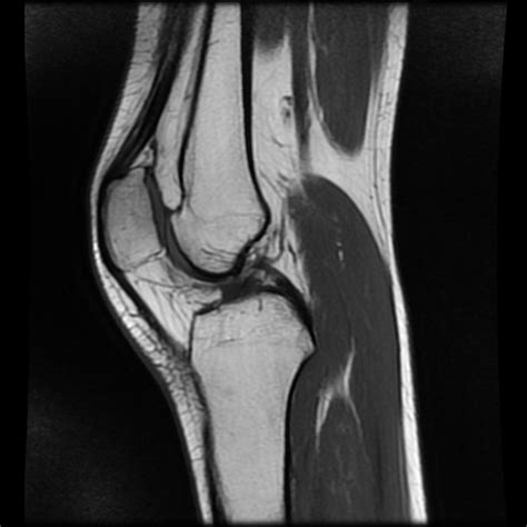 Synovial Sarcoma Knee Image
