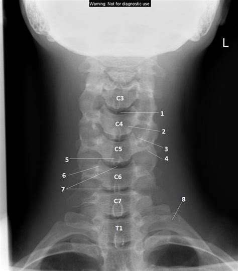 Interpreting Cervical Spine Radiographs The Bmj