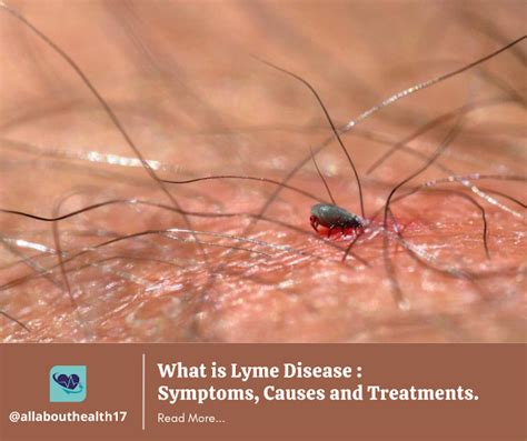 What Is Lyme Disease Symptoms Causes And Treatments Lyme Disease