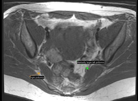 33 Year Old Woman With Piriformis Syndrome Neurography Institute