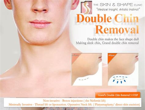 Neck Lift For Double Chin Get Rid Of That Extra Skin Under Your Chin