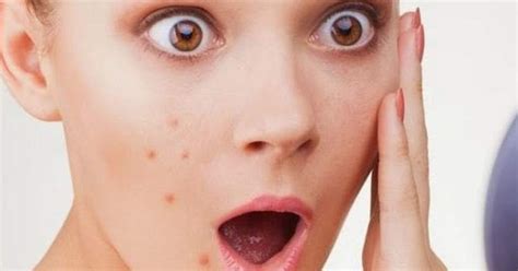 Pasti biayanya enggak sedikit, kan? Cara Menghilangkan Noda Flek Hitam Bekas Jerawat