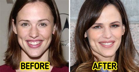 Celebrity Smile Before And After