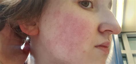 Skin Concerns Is This Redness On My Cheeks Normal Skincareaddiction